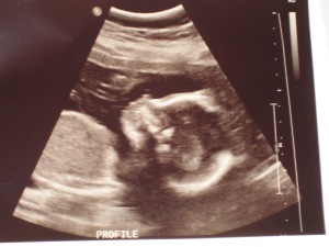 This is the less-alien looking of our ultrasound photos. It looks pretty similar to one we have of Lewis, but I imagine most peoples blurry ultrasound photos of baby-in-profile look pretty similar?